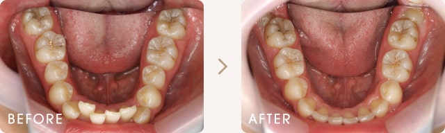 舌側（裏側）矯正による出っ歯とでこぼこの改善例 写真c