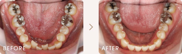 八重歯と前歯のでこぼこの改善例 写真c