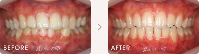 出っ歯と正中線のずれの改善例 写真a