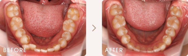 出っ歯と正中線のずれの改善例 写真c