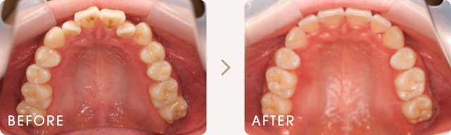 ハーフリンガルによる前歯のでこぼこの改善例 写真b