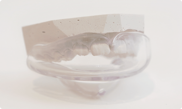 使用装置例：歯列矯正用咬合誘導装置（ムーシールド） 写真