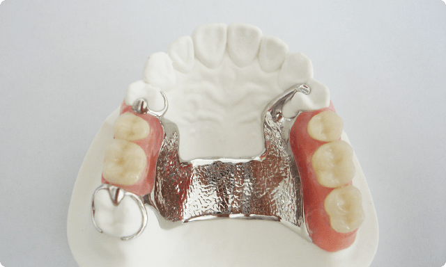 金属床 義歯（入れ歯） 写真