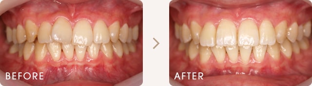 部分矯正による前歯のねじれの改善例 写真a