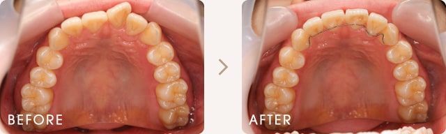 部分矯正による前歯のねじれの改善例 写真b