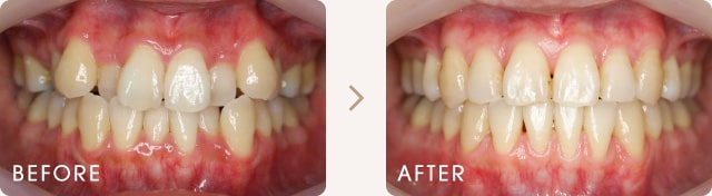 八重歯と前歯のでこぼこの改善例 写真a