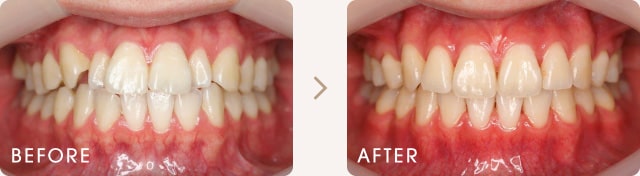 ハーフリンガルによる前歯のでこぼこの改善例 写真a