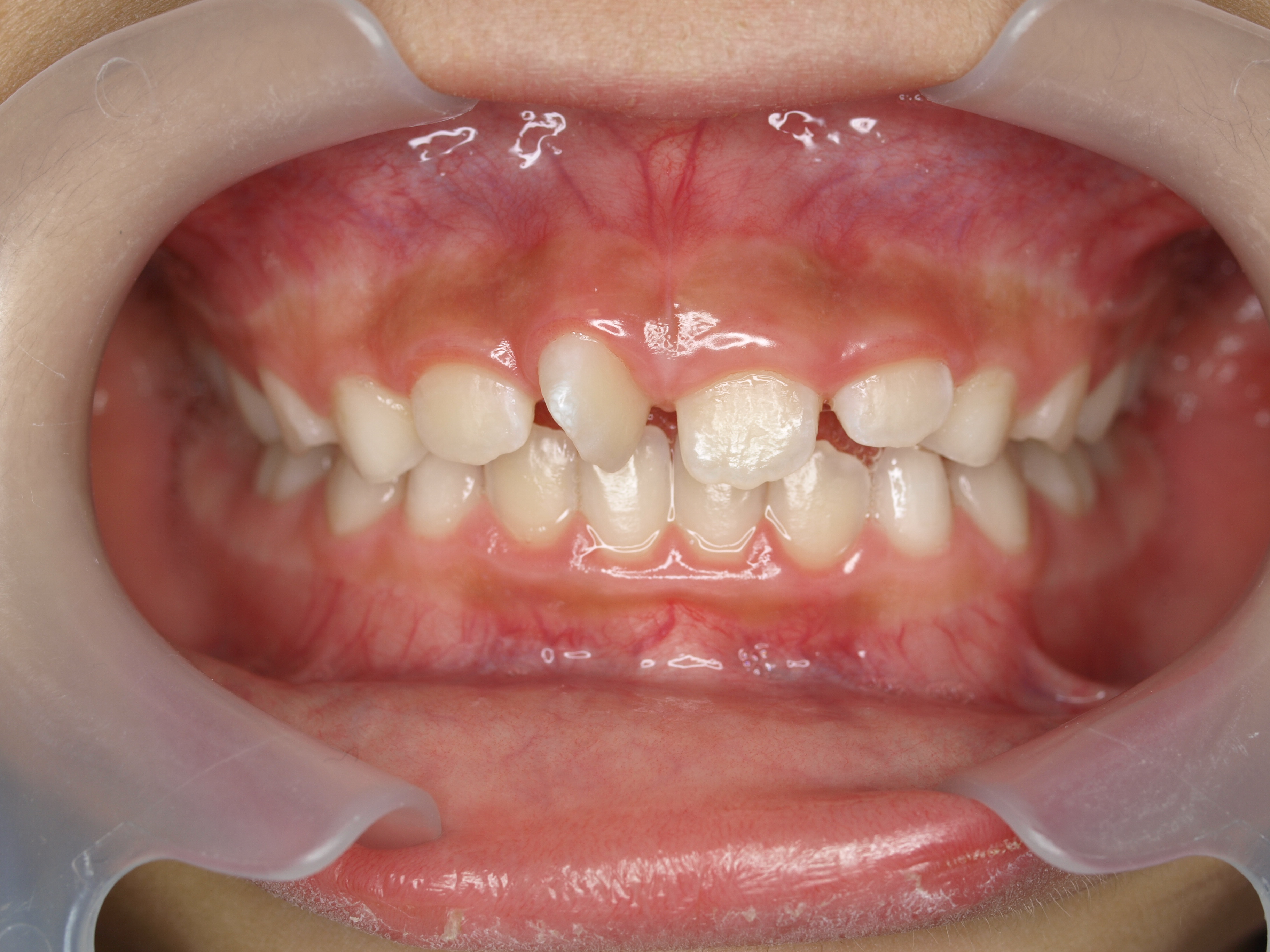 歯 の 矯正 短期 間